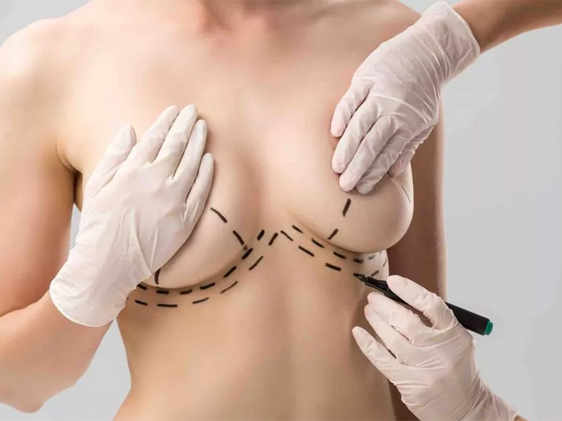 Breast Reduction Aesthetics4 Breast Lift Aesthetics