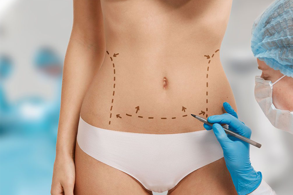 Tummy Tuck Tummy Tuck (Abdominoplasty)